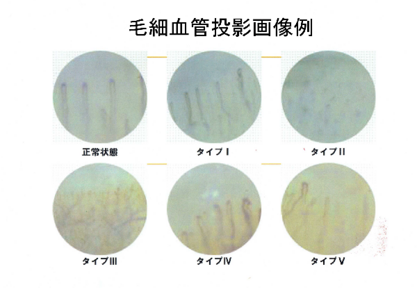 毛細血管投影画像例